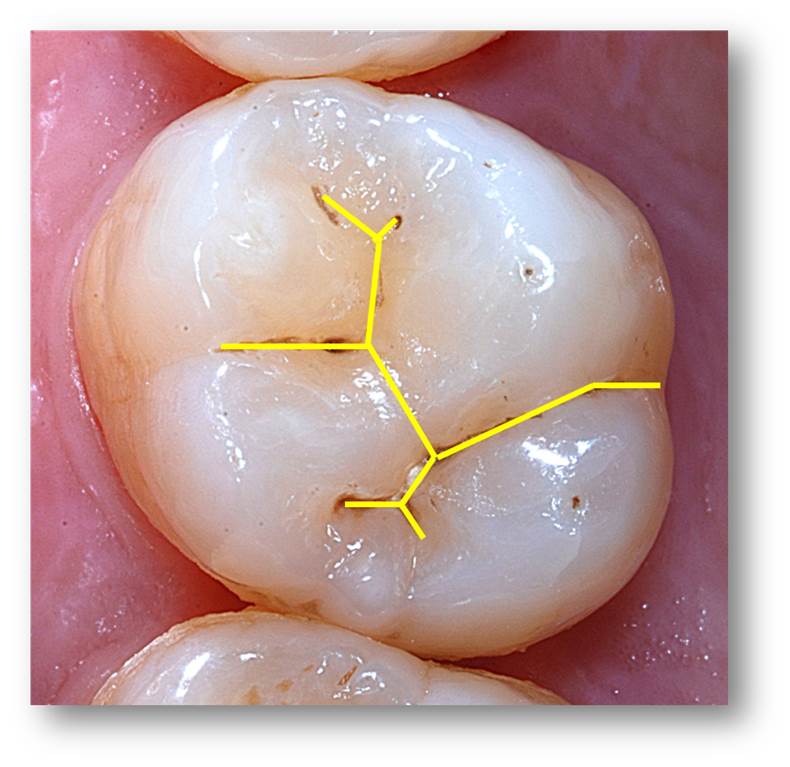 Molar Tooth Anatomy