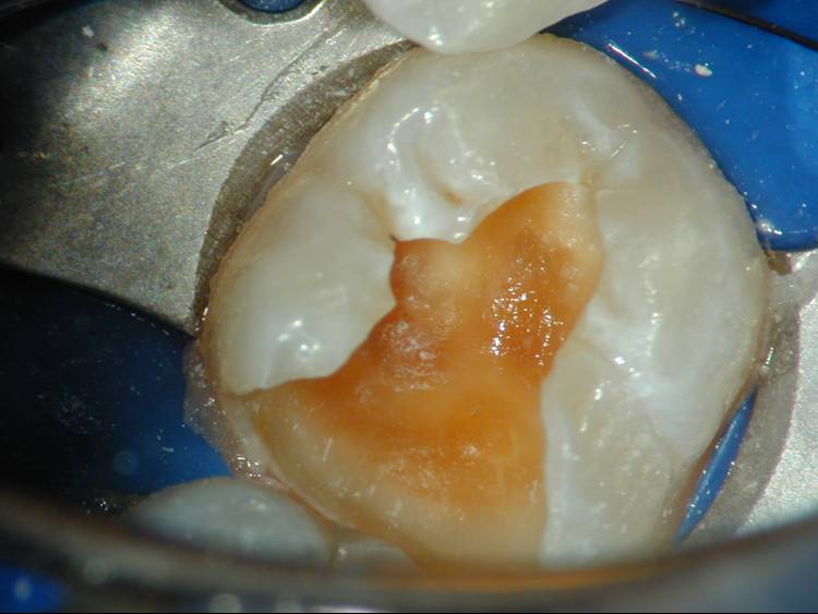 Endodontics Pulp Capping Enhanced Dental CPD Online