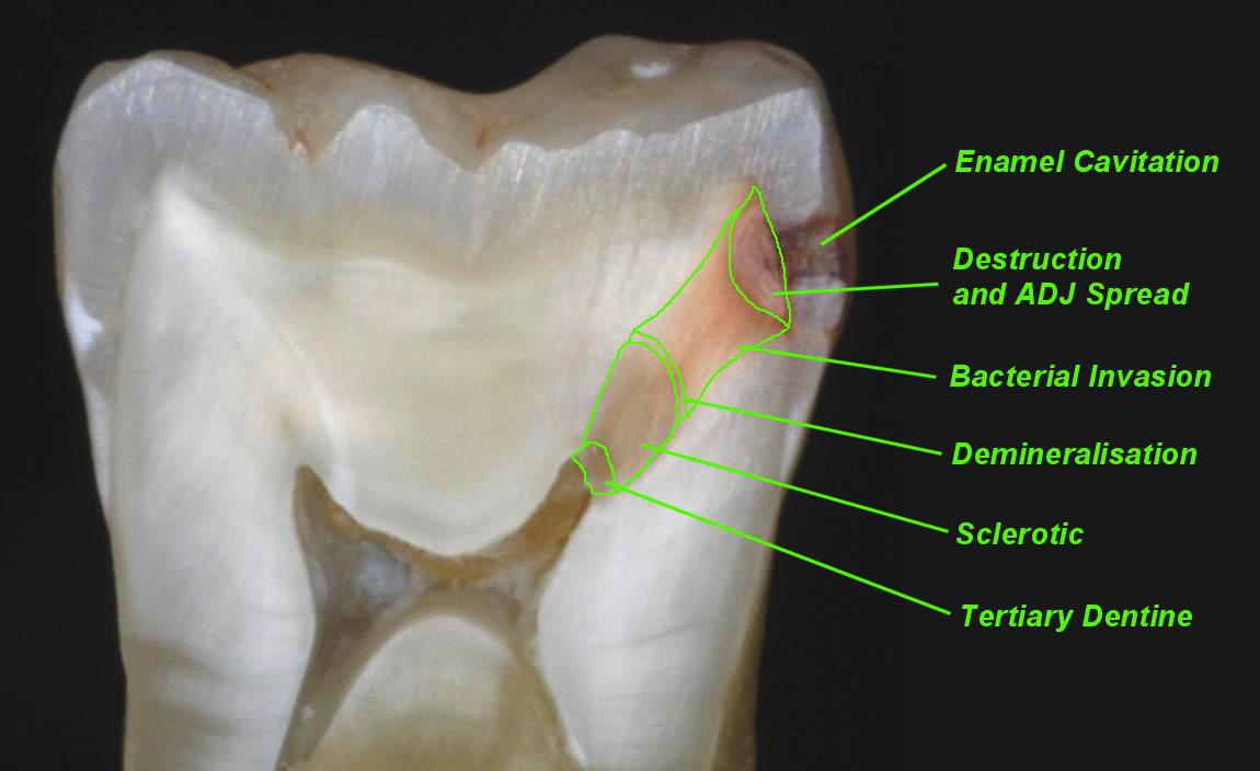 Diagnosis: dental caries. dentine caries