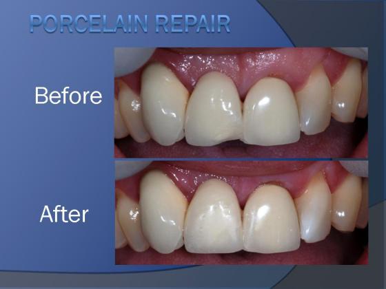 Damaged Tooth Repair: Porcelain Crown