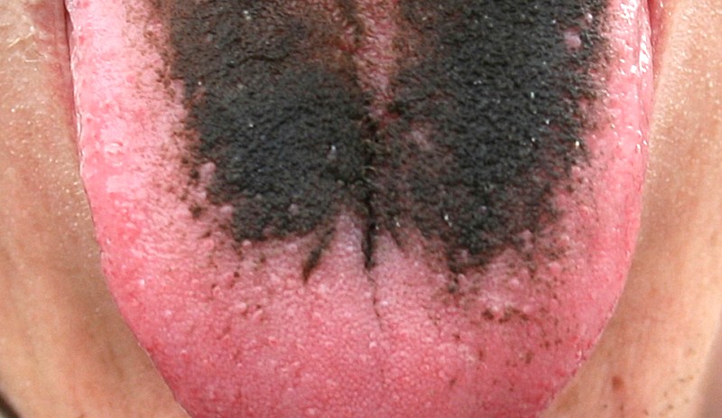Black Hairy Tongue  Enhanced Dental CPD Online